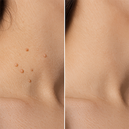 Eliminación de verrugas en el cuello, antes y después